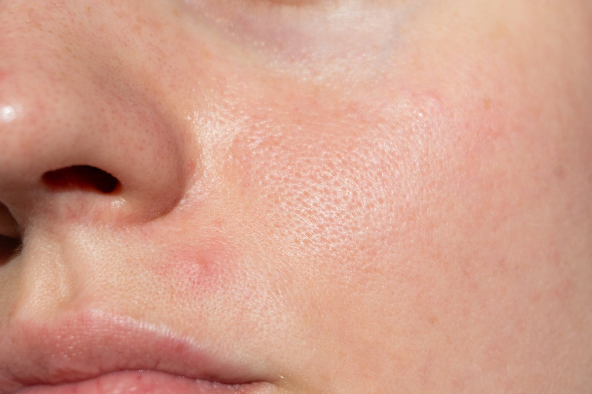 Acne Favorites