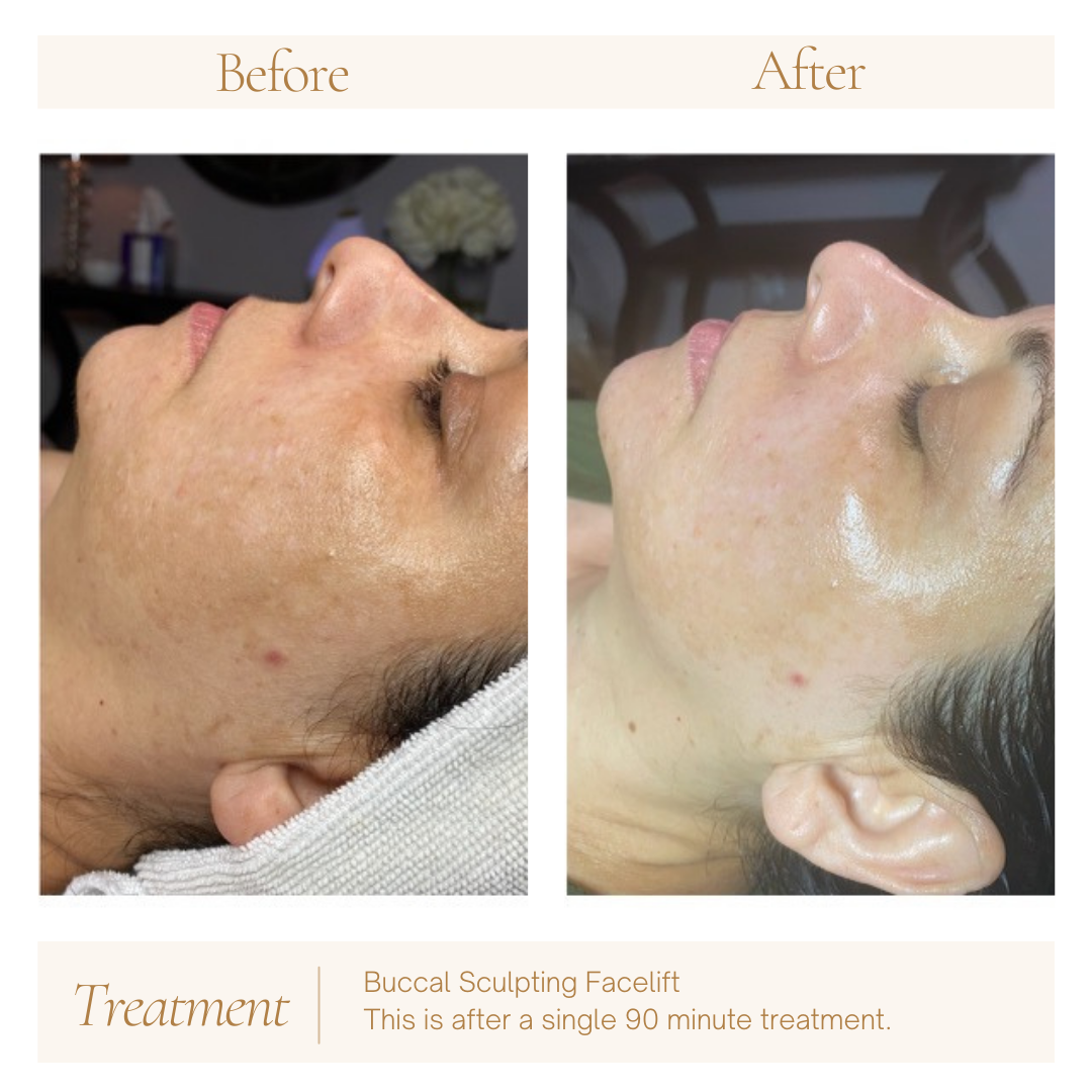 Buccal Sculpting Facelift — before