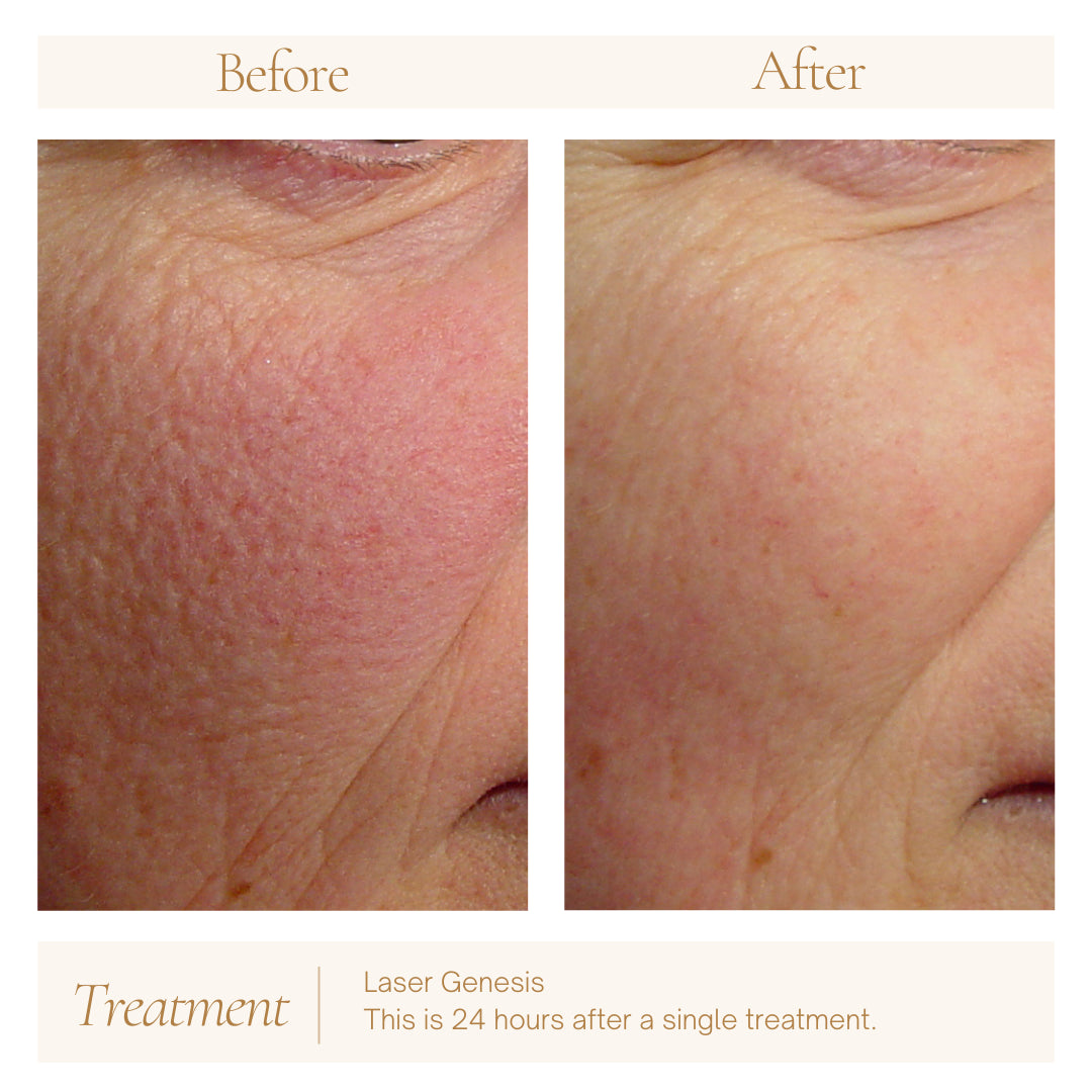 Laser Genesis — before
