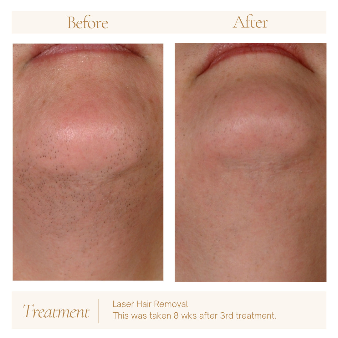 Laser Hair Removal — before