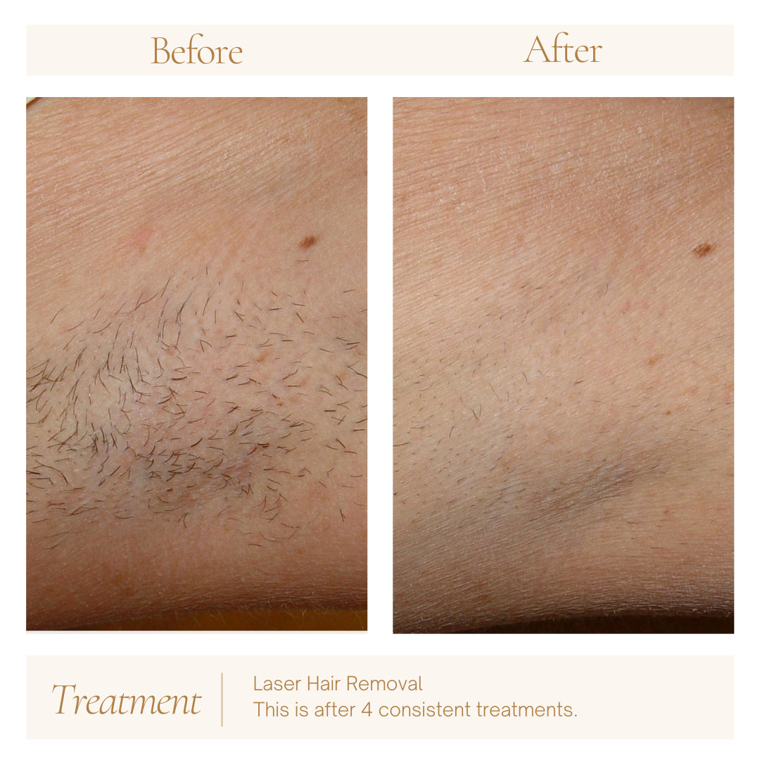 Laser Hair Removal — before