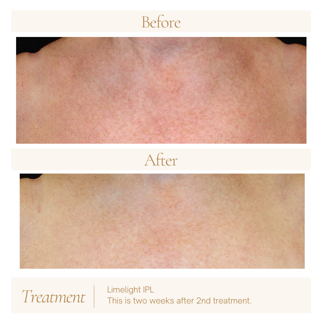 Limelight IPL — before