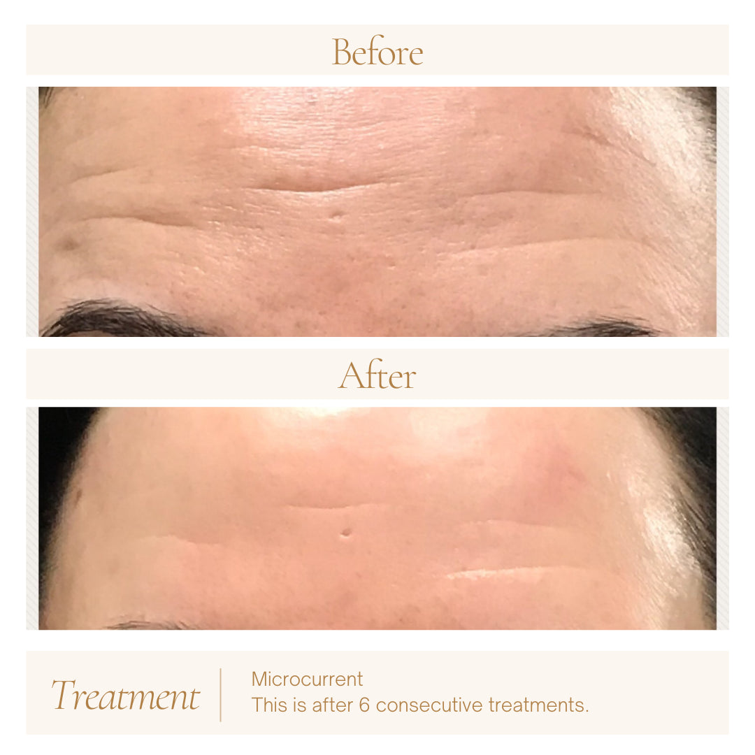 Microcurrent — before