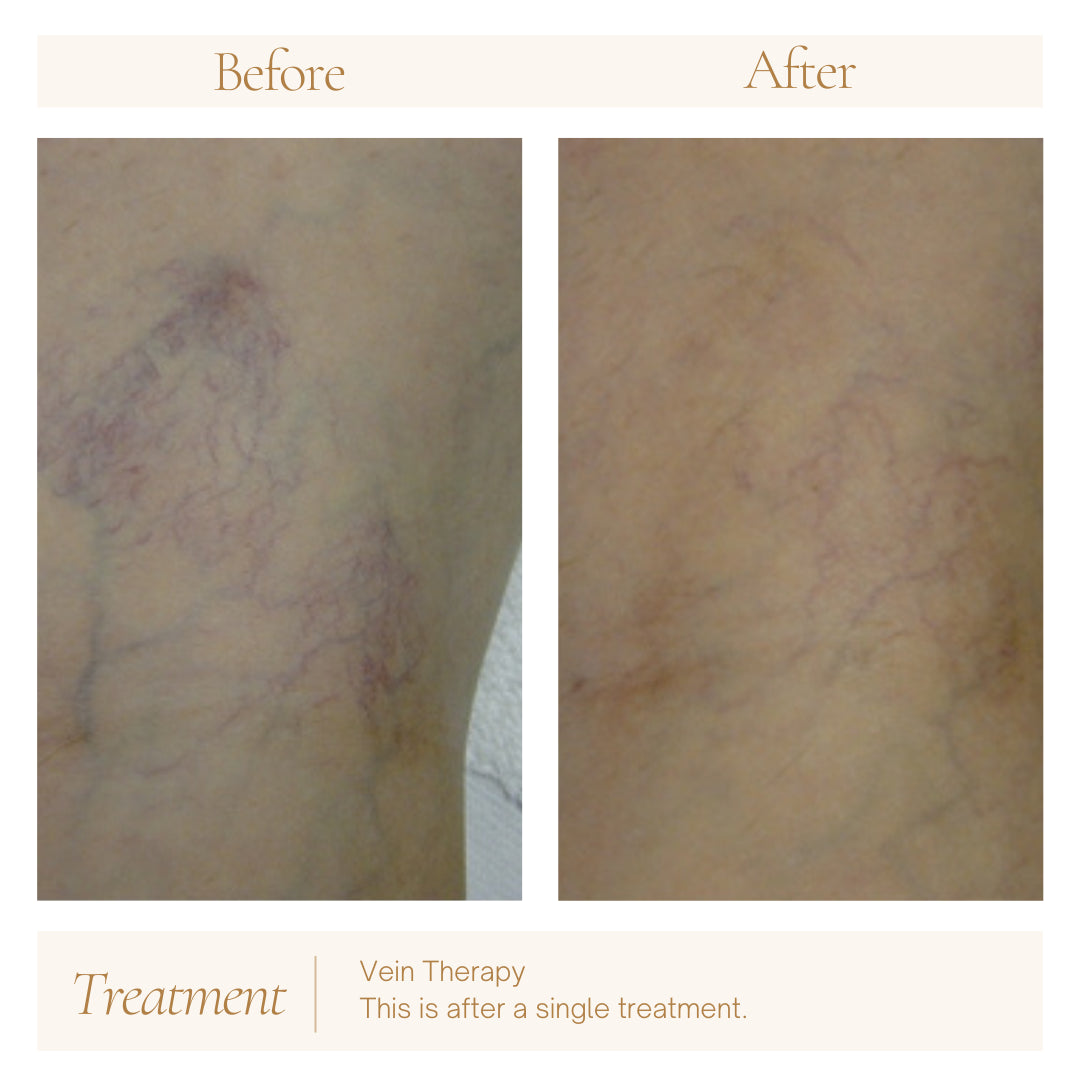 Vein Therapy — before